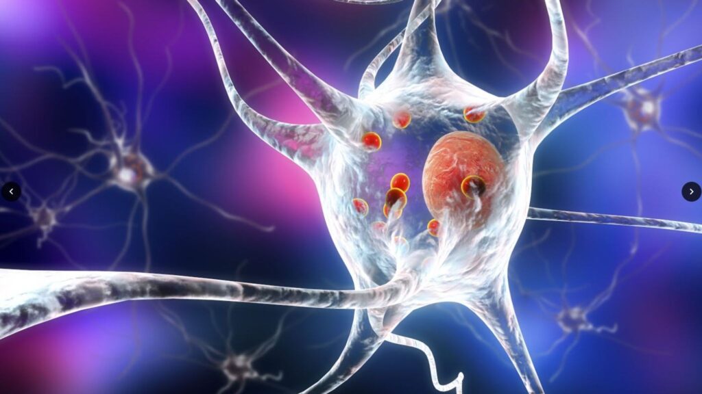 Fattori di rischio per lo sviluppo della demenza nella malattia di Parkinson 