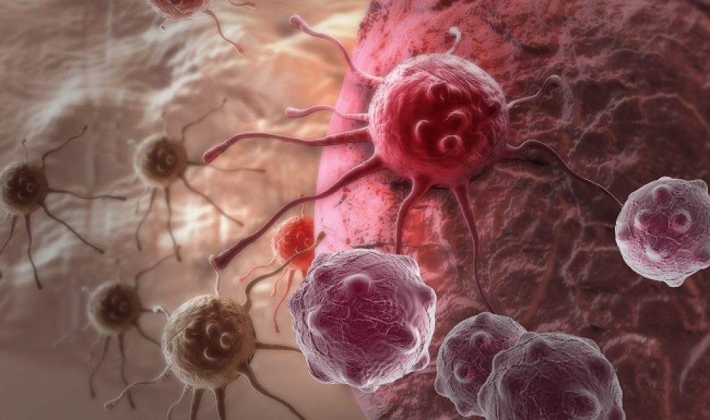 Ricerca. Svelata una causa genetica per cancro raro al seno