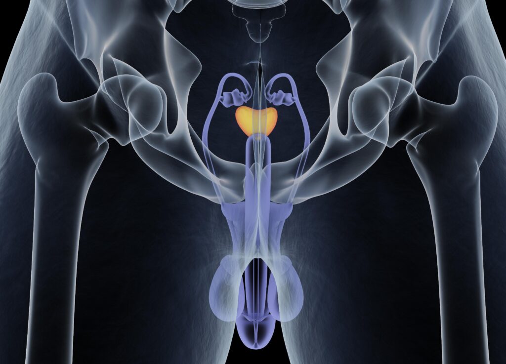 L’intelligenza artificiale nel trattamento del cancro alla prostata 