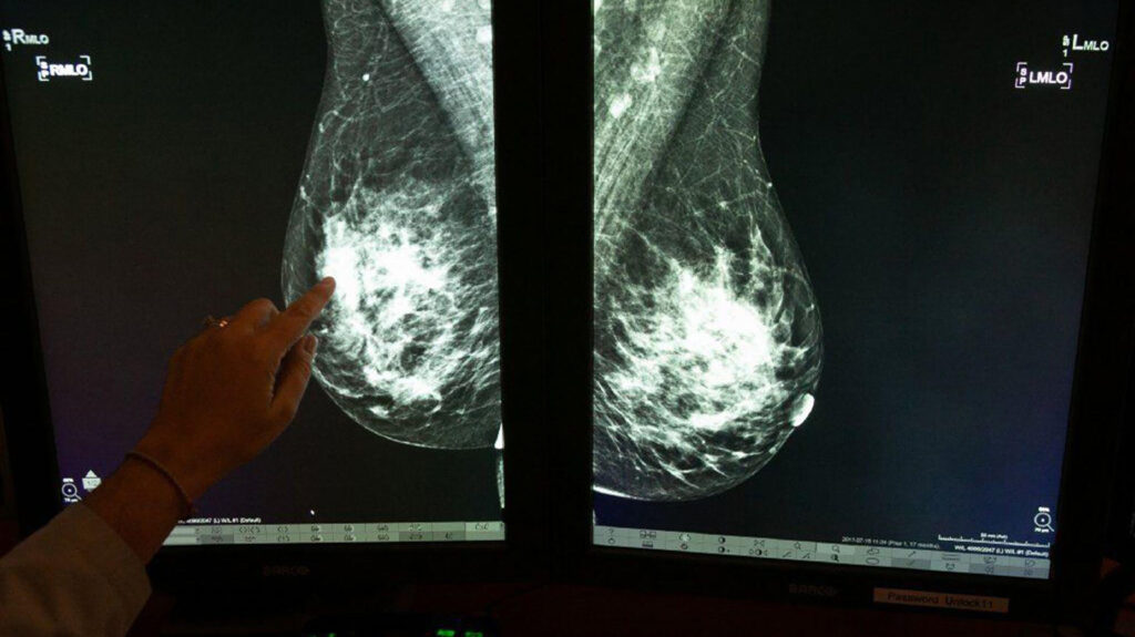 Tumore al seno. La diagnosi precoce salva migliaia di vite