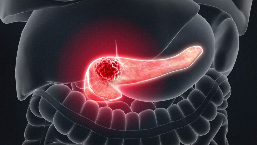 Tumore pancreas: scoperto come le cellule proliferano