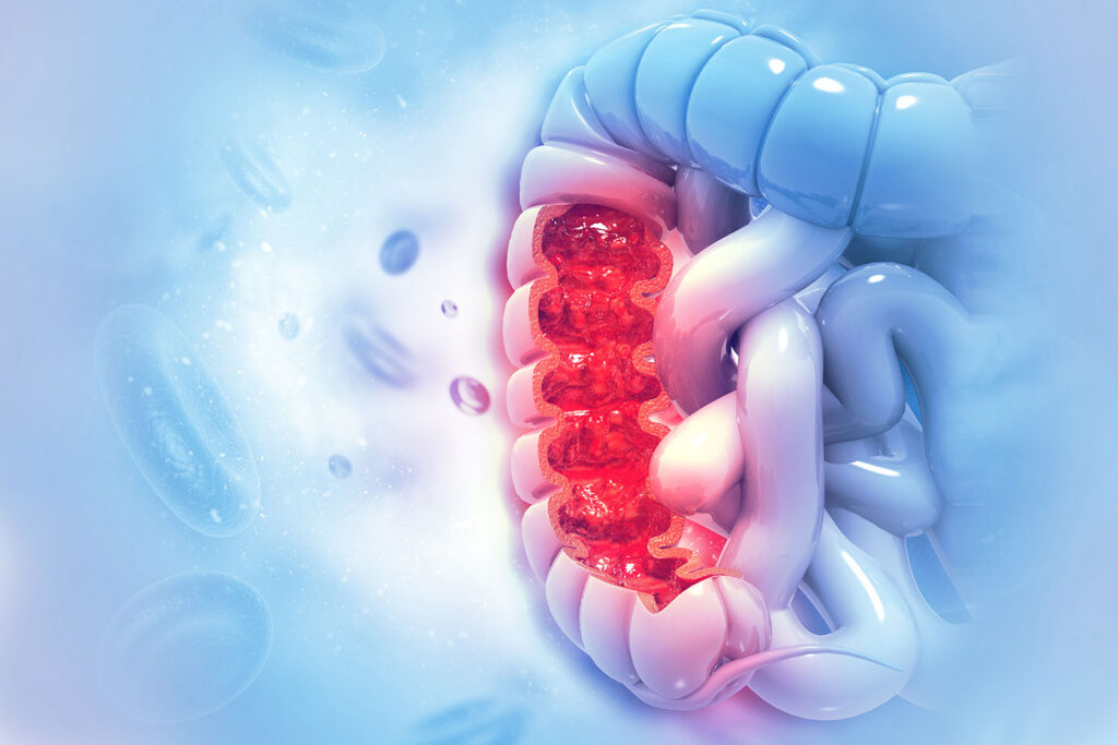Nuove scoperte per contrastare il tumore del colon-retto
