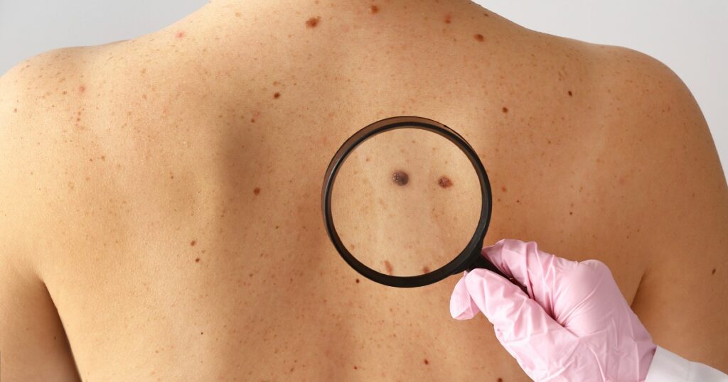 Il Regno Unito lancia l’allarme dei melanomi