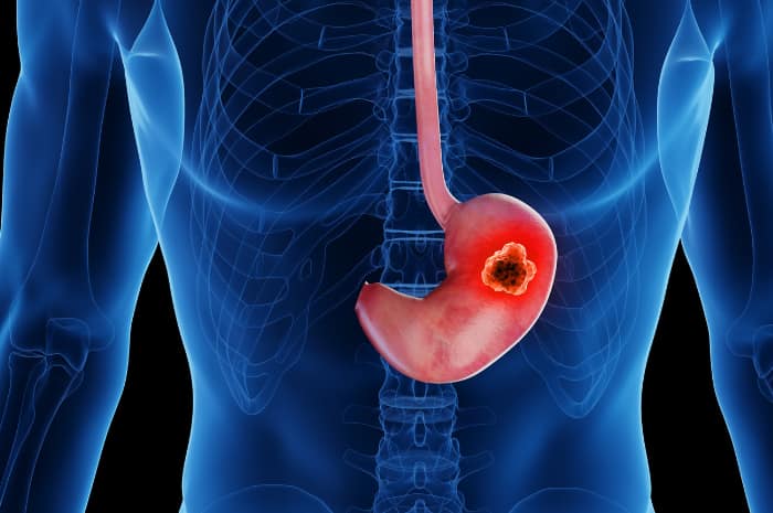 Nanoparticelle: una nuova frontiera nella lotta contro il carcinoma gastrico