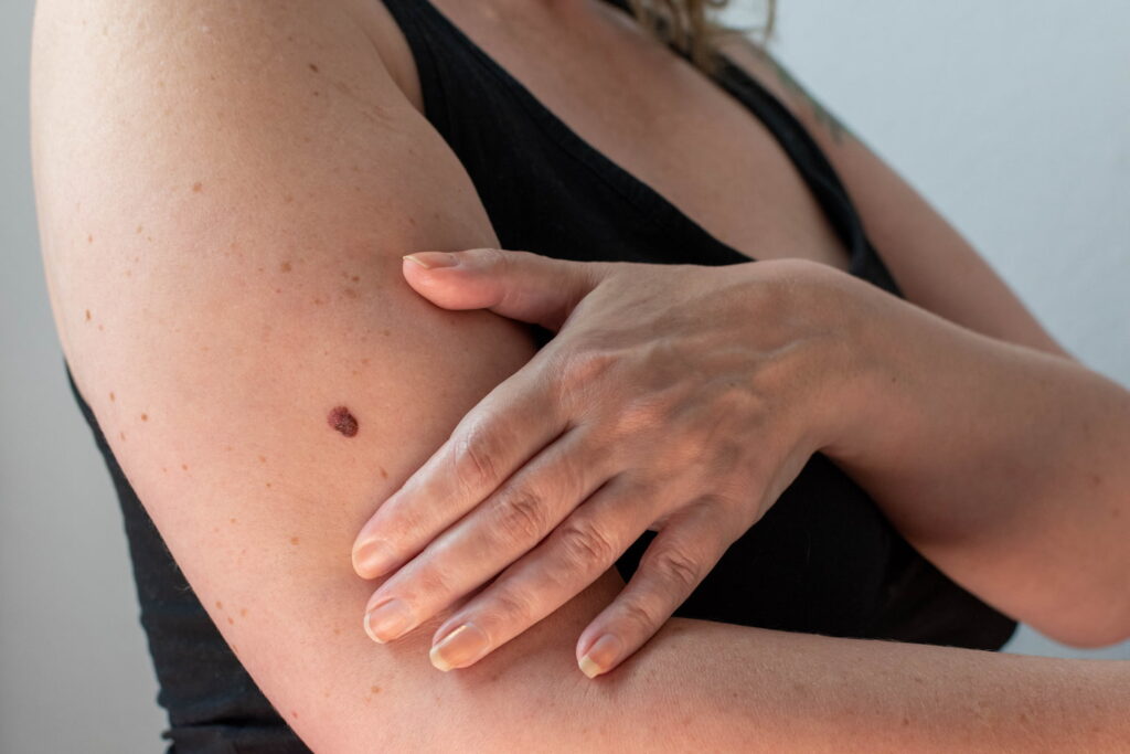 Una terapia personalizzata per il melanoma e il tumore al polmone