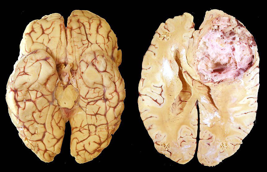 Un esame del sangue per diagnosticare il tumore al cervello