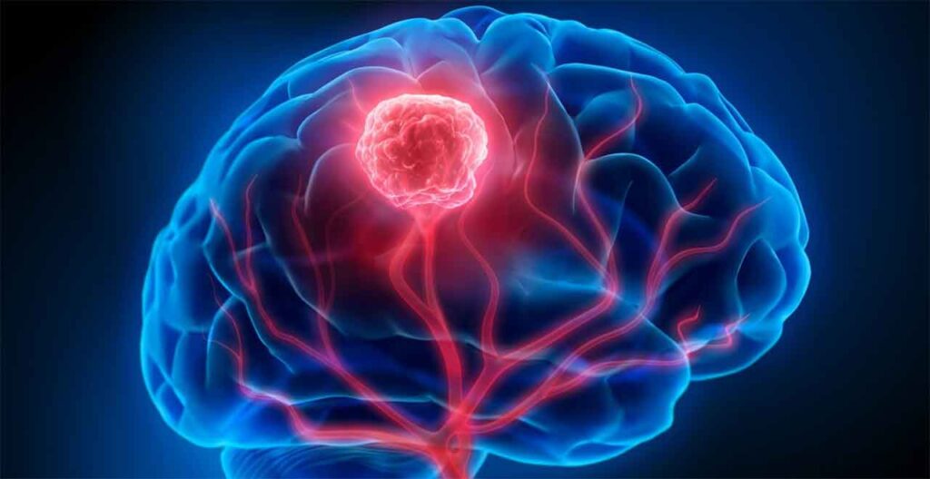 Una nuova terapia apre speranze nel trattamento del glioblastoma