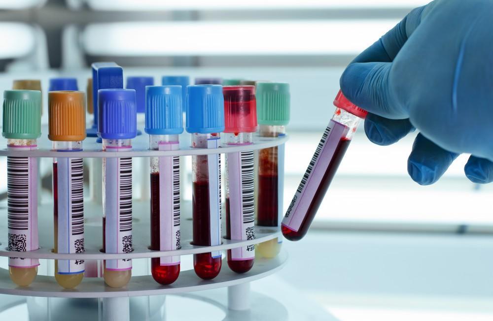 Ricerca. Un test del sangue per rivelare la Sla