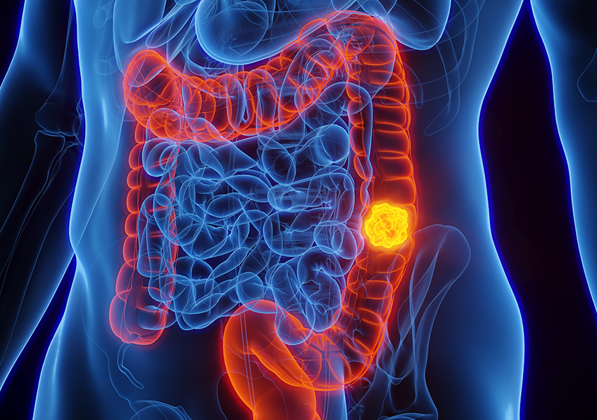 I batteri intestinali svelano nuovi strumenti per identificare il cancro