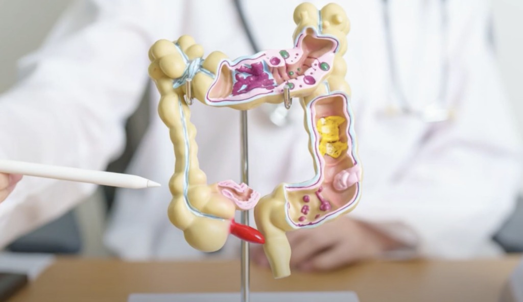 Microbiota e dieta: alleati per la prevenzione del tumore al colon-retto
