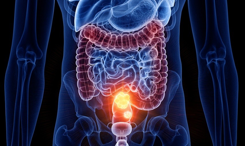 Un algoritmo prevede l’efficacia dei farmaci nella terapia del cancro al colon