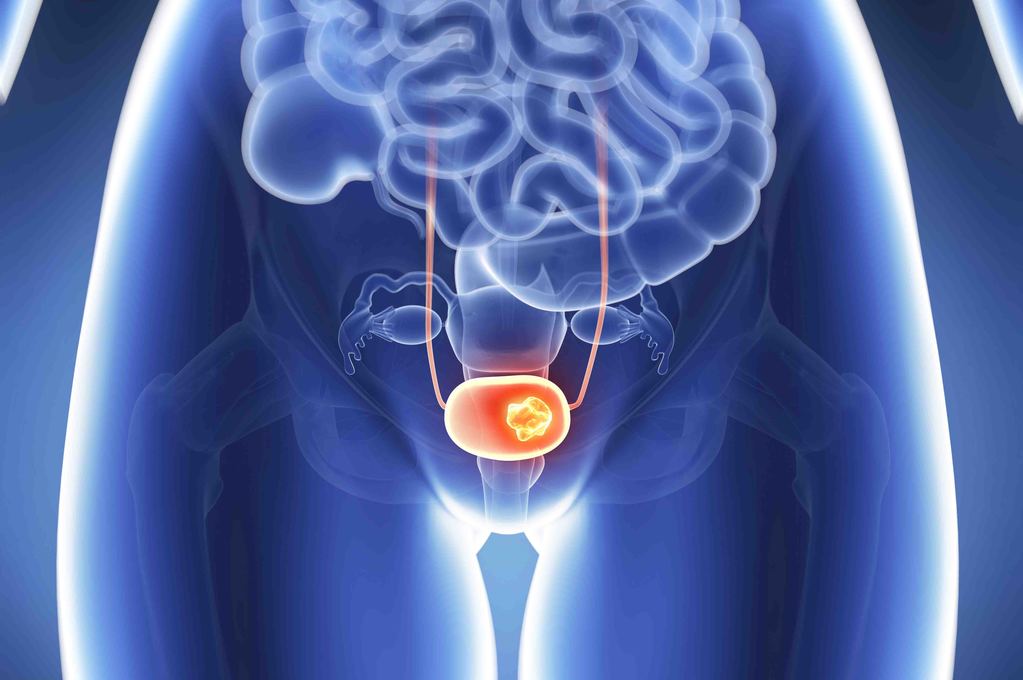Tumore della vescica: scoperto nuovo meccanismo molecolare per cure e diagnosi