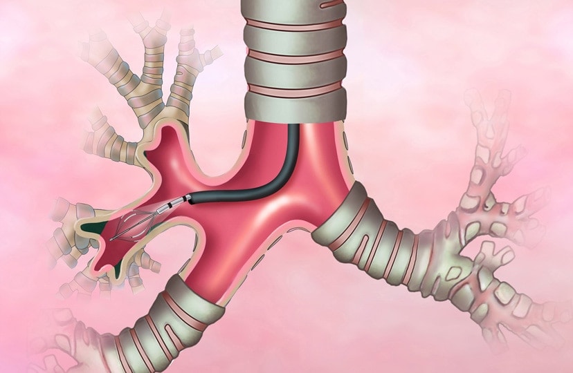 Tumore al polmone. Allo IEO un broncoscopio robotico per diagnosi avanzate