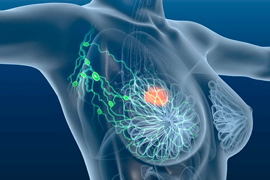 Immunoterapia e tumore al seno: nuove prospettive nella lotta al carcinoma mammario
