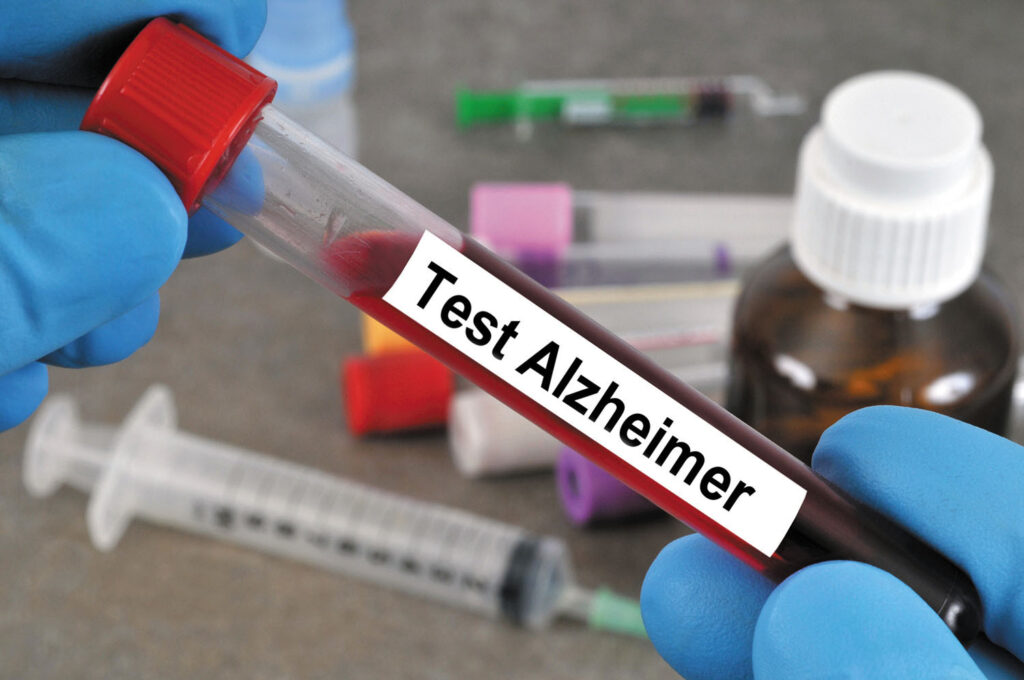 Alzheimer, un test rivoluzionario del sangue per la diagnosi precoce