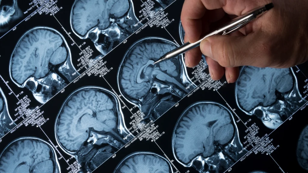 L’Intelligenza artificiale nella diagnosi di Alzheimer e Parkinson