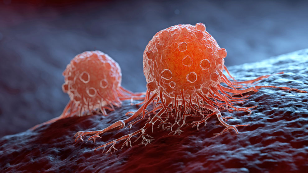 Un nuovo trattamento per il cancro potrebbe fermare la crescita dei tumori