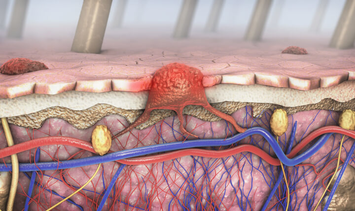 Melanoma: un mix di batteri intestinali potrebbe migliorare l’efficacia dell’immunoterapia