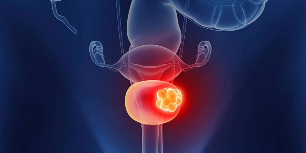 Tumori uroteliali. A Padova nasce Ves.Pa, la vescica artificiale senza corpo estraneo